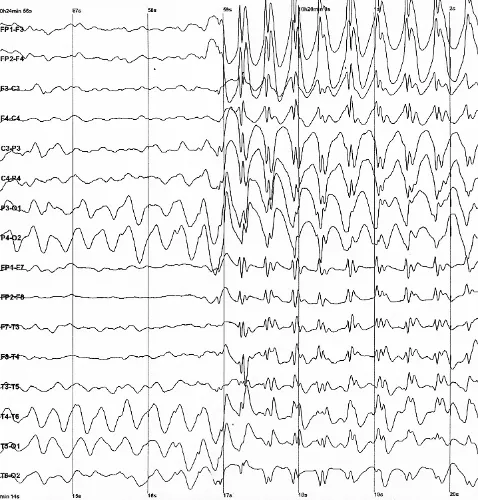 L'electroencephalographie s'impose comme un outil diagnostique indispensable en neurologie moderne